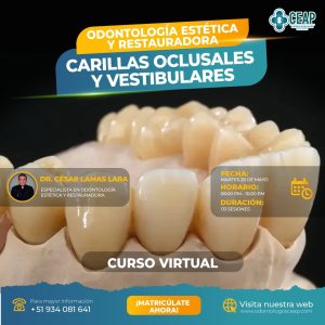 Curso Carillas Oclusales y Vestibulares
